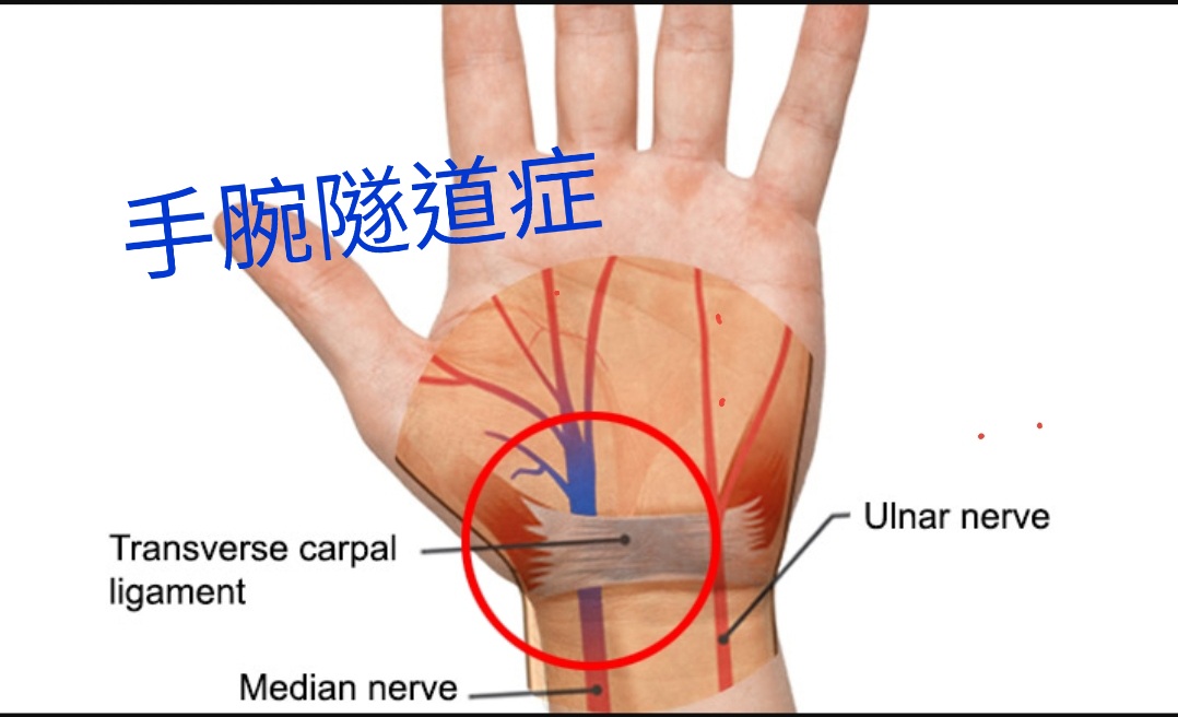 外科術後沾黏造成的手腕隧道症如何解?